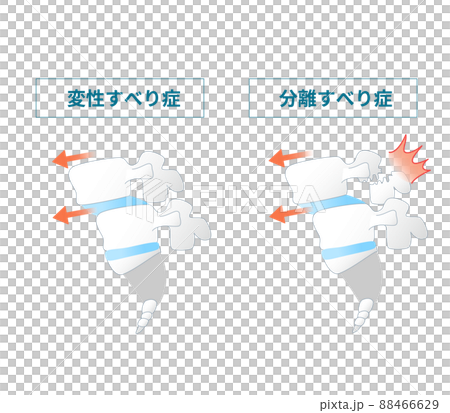 脊椎すべり症の図解イラスト 88466629