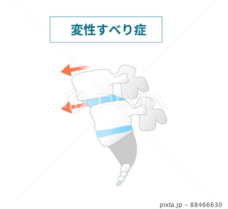 脊椎すべり症の図解イラスト 88466630