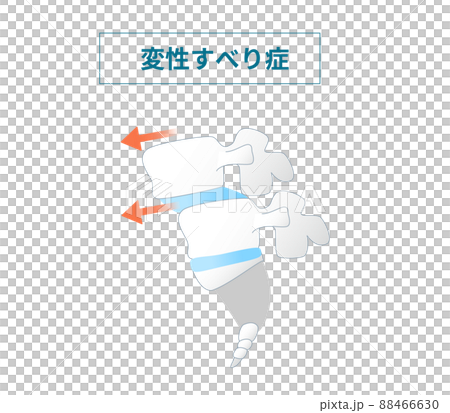 脊椎すべり症の図解イラスト 88466630