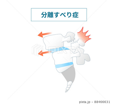 脊椎すべり症の図解イラスト 88466631