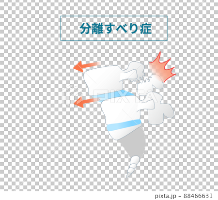 Illustrated illustration of spondylolisthesis Illustrated illustration of spondylolisthesis 88466631