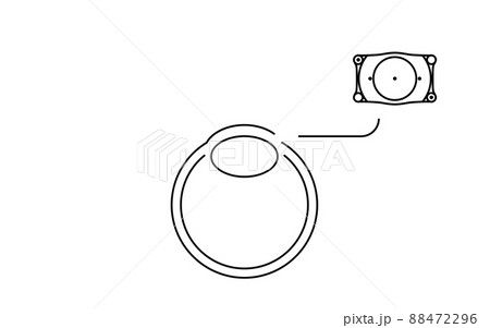ICL(眼内コンタクトレンズ)手術、ICL挿入の図解 ICL(眼内コンタクトレンズ)手術、ICL挿入の図解 88472296