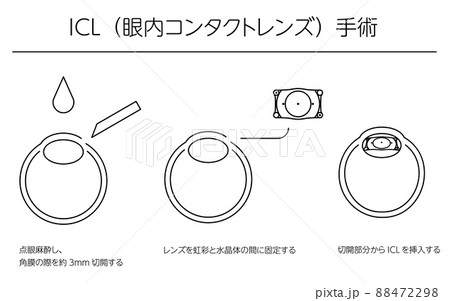 ICL（眼内コンタクトレンズ）手術、図解 88472298