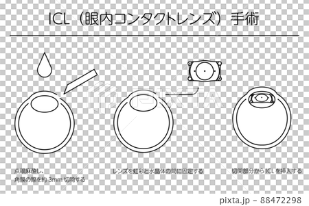 ICL（眼内コンタクトレンズ）手術、図解 88472298