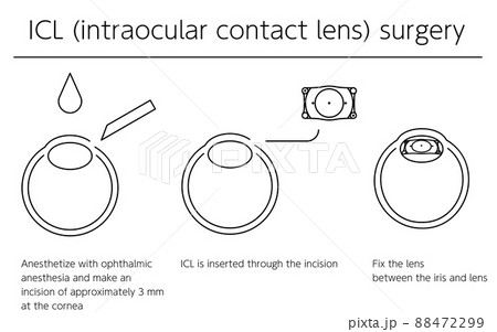 ICL（眼内コンタクトレンズ）手術、図解 88472299