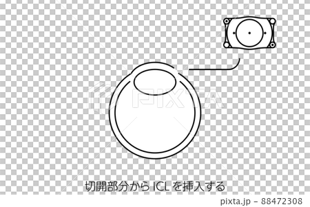 Illustrated ICL (Intraocular Contact Lens) Surgery, ICL Insertion 88472308
