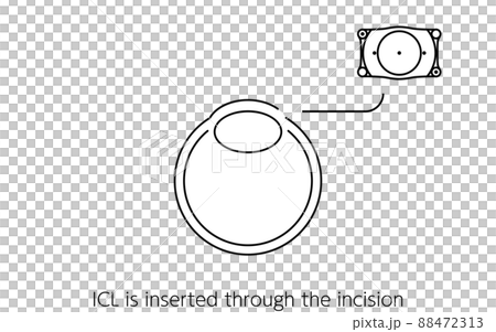 Illustrated ICL (Intraocular Contact Lens) Surgery, ICL Insertion Illustrated ICL (Intraocular Contact Lens) Surgery, ICL Insertion 88472313