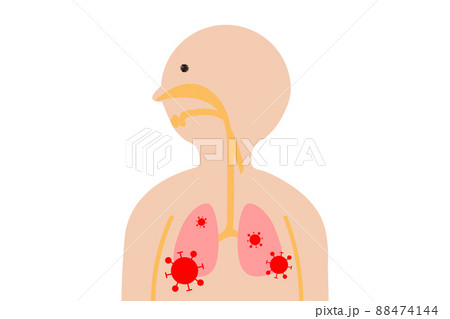 肺炎のイラストのイラスト素材