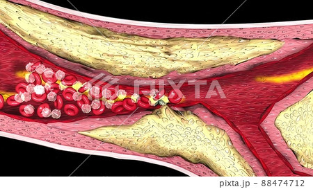 Coronary atherosclerosis, light micrograph showing cholesterol-containing plaque 88474712
