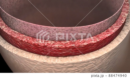 Aortic aneurysm and aortic dissection Aortic aneurysm and aortic dissection 88474940