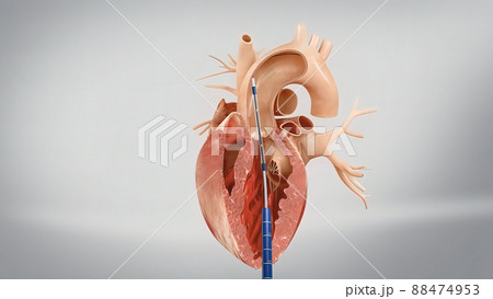 Coronary reimplantation in ascending aortic aneurysm Coronary reimplantation in ascending aortic aneurysm 88474953