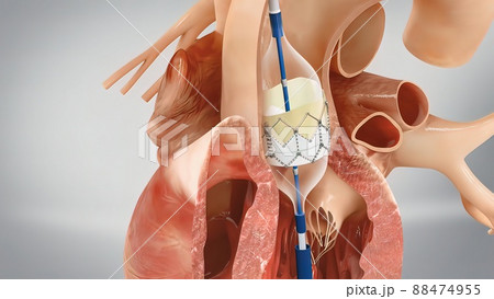 Coronary reimplantation in ascending aortic aneurysm Coronary reimplantation in ascending aortic aneurysm 88474955