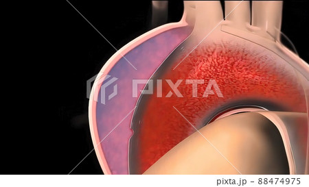 It may affect the left ventricle, aorta, aortic valve, or mitral valve. It may affect the left ventricle, aorta, aortic valve, or mitral valve. 88474975