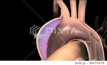It may affect the left ventricle, aorta, aortic valve, or mitral valve. 88474978
