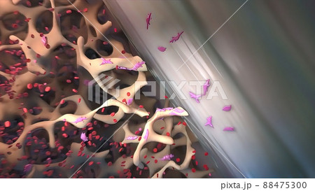 Osteosarcoma is a cancer of the bone that is most common in adolescents. 88475300