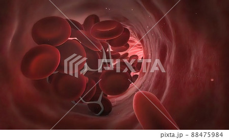 Blood clotting vascular occlusion 3d medical anatomy Blood clotting vascular occlusion 3d medical anatomy 88475984