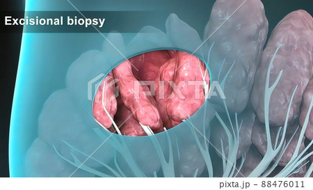Breast cancer Girl with breast pathology. . Illustration and close-up of female human structure. 88476011