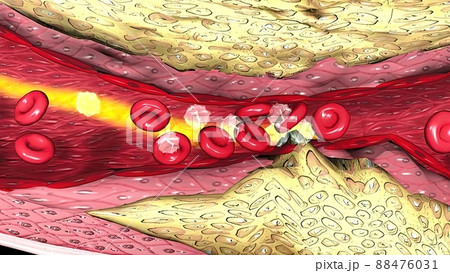 Coronary atherosclerosis, light micrograph showing cholesterol-containing plaque 88476031