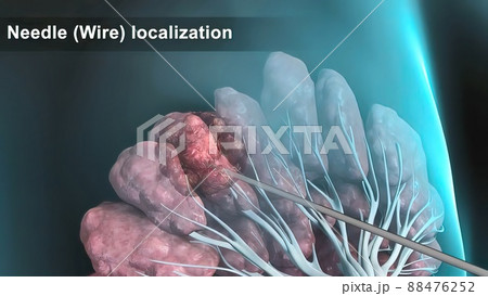 Breast cancer Girl with breast pathology. . Illustration and close-up of female human structure. 88476252