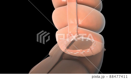 surgery to remove any part of the intestines, bowel resection surgery to remove any part of the intestines, bowel resection 88477411