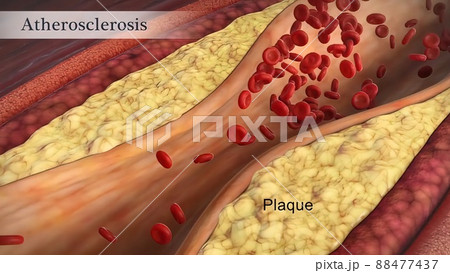 Clogged Artery with platelets and cholesterol plaque, concept for health risk for obesity 88477437