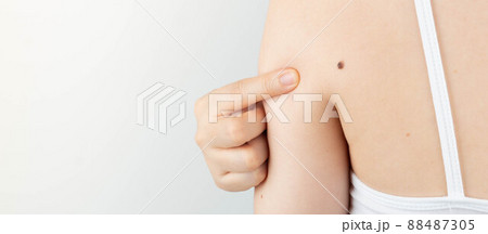 Young woman pointing at dark brown moles on her back for self-exams skin. Being aware of changes in your moles to detecting skin cancer, especially malignant melanoma. Skin disease concept. 88487305