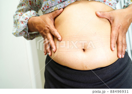 Overweight asian woman use hand to squeeze fat belly big size overweight and obesity. Overweight asian woman use hand to squeeze fat belly big size overweight and obesity. 88496931