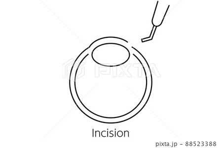 白内障手術の流れ、図解イラスト（線画）、切開する 88523388