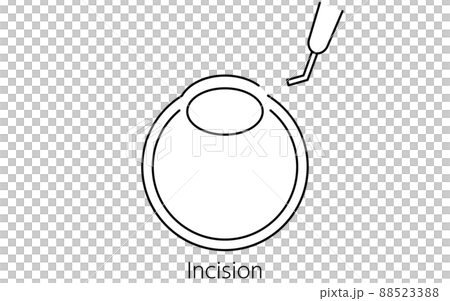 白内障手術の流れ、図解イラスト（線画）、切開する 88523388