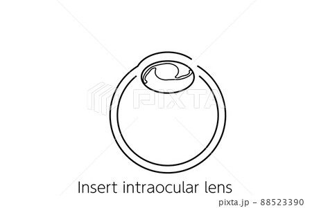 白内障手術の流れ 図解イラスト 線画 眼内レンズを挿入するのイラスト素材