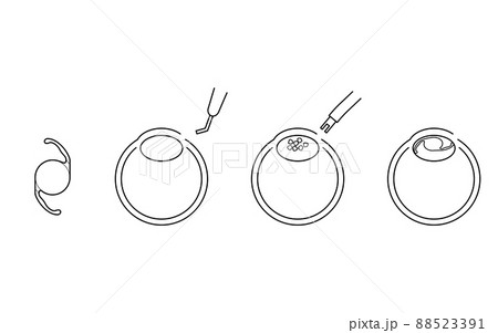 白内障手術の流れ、図解イラスト(線画) 白内障手術の流れ、図解イラスト(線画) 88523391
