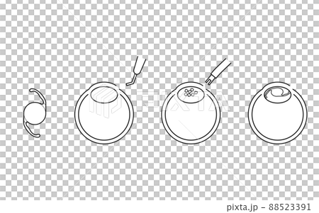 白内障手術の流れ、図解イラスト(線画) 白内障手術の流れ、図解イラスト(線画) 88523391