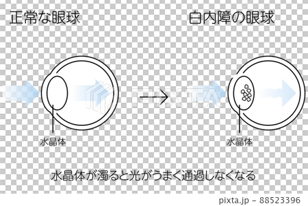 正常眼球和白內障眼球,插圖(線條圖) 正常眼球和白內障眼球,插圖(線條圖) 88523396