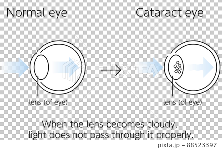 Normal eyeball and cataract eyeball, illustrated illustration (line drawing) 88523397