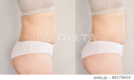 Before and after belly operation. Surgery cellulite tummy plastic change Before and after belly operation. Surgery cellulite tummy plastic change 88579659