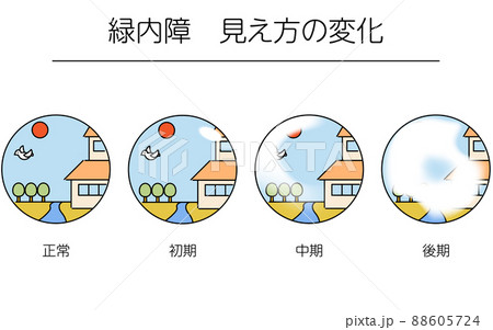 緑内障の図解、緑内障の進行による視野の変化、メディカル
