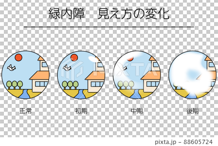 緑内障の図解、緑内障の進行による視野の変化、メディカルイラスト 88605724
