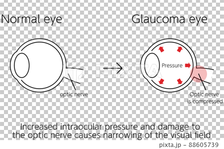 青光眼如何工作的插圖，正常和青光眼眼球，醫學插圖 88605739