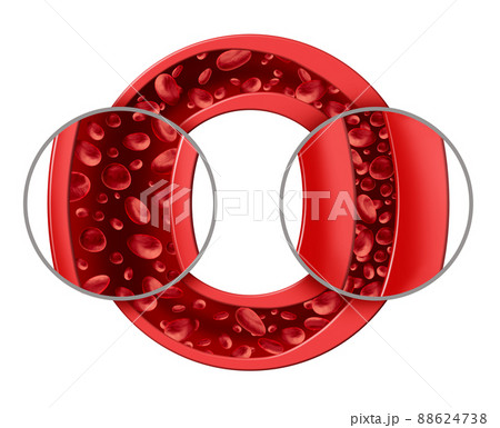 Hypertension And High Blood pressure 88624738