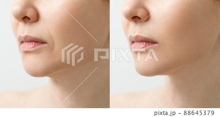 A close portrait of an aged woman before and after facial rejuvenation procedure. Correction of the chin shape liposuction of the neck. The result of the procedure in the clinic of aesthetic medicine. A close portrait of an aged woman before and after facial rejuvenation procedure. Correction of the chin shape liposuction of the neck. The result of the procedure in the clinic of aesthetic medicine. 88645379