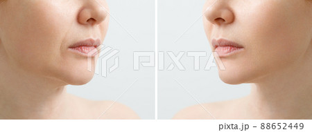 A close portrait of an aged woman before and after facial rejuvenation procedure. Correction of the chin shape liposuction of the neck. The result of the procedure in the clinic of aesthetic medicine. A close portrait of an aged woman before and after facial rejuvenation procedure. Correction of the chin shape liposuction of the neck. The result of the procedure in the clinic of aesthetic medicine. 88652449