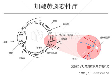 眼病、加齢黄斑変性症の図解 眼病、加齢黄斑変性症の図解 88659878