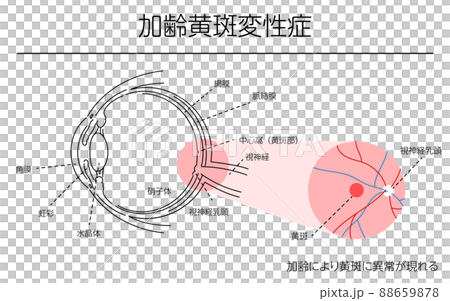 Illustration of eye disease and age-related macular degeneration 88659878