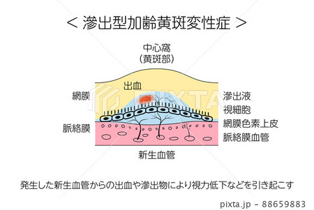 眼病、滲出型加齢黄斑変性症の図解 眼病、滲出型加齢黄斑変性症の図解 88659883