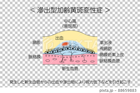 眼病、滲出型加齢黄斑変性症の図解 眼病、滲出型加齢黄斑変性症の図解 88659883