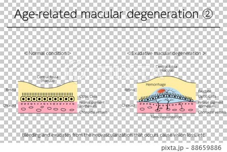 Illustration of eye disease, exudative age-related macular degeneration 88659886