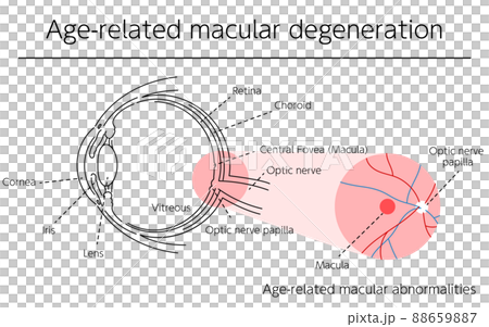Illustration of eye disease and age-related macular degeneration 88659887