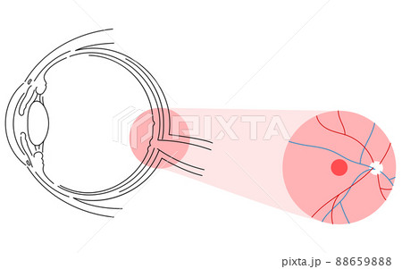 眼病、加齢黄斑変性症の図解 眼病、加齢黄斑変性症の図解 88659888