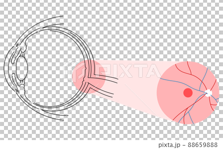 Illustration of eye disease and age-related macular degeneration 88659888
