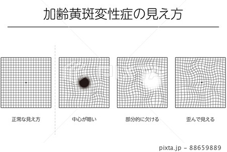 眼病、加齢黄斑変性症の見え方の図解 眼病、加齢黄斑変性症の見え方の図解 88659889